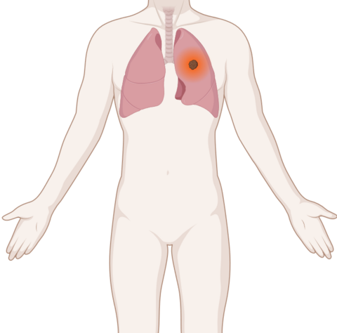 Schematische, anatomische Darstellung einer Lunge mit leuchtendem Tumor