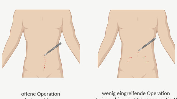 Grafische Darstellung der notwendigen Hautschnitte bei einer radikalen Prostatektomie: bei einer retropubischen Operation wird ein Längsschnitt zwischen Nabel und Schambein des Patienten gemacht. Bei einem wenig eingreifenden (minimal-invasiven) Vorgehen, wie der Roboter-assistierten OP, macht der Chirurg oder die Chirurgin mehrere kleine Schnitte in die Bauchdecke.