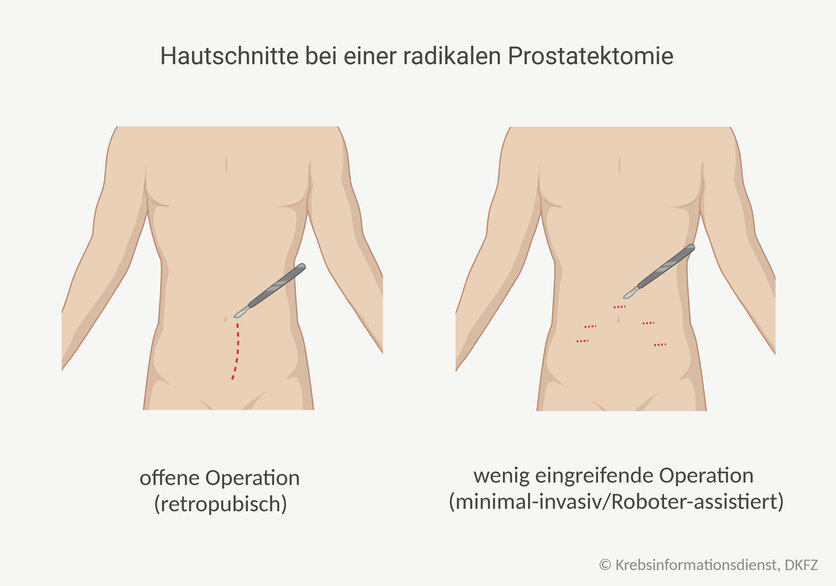 Grafische Darstellung der notwendigen Hautschnitte bei einer radikalen Prostatektomie: bei einer retropubischen Operation wird ein Längsschnitt zwischen Nabel und Schambein des Patienten gemacht. Bei einem wenig eingreifenden (minimal-invasiven) Vorgehen, wie der Roboter-assistierten OP, macht der Chirurg oder die Chirurgin mehrere kleine Schnitte in die Bauchdecke.