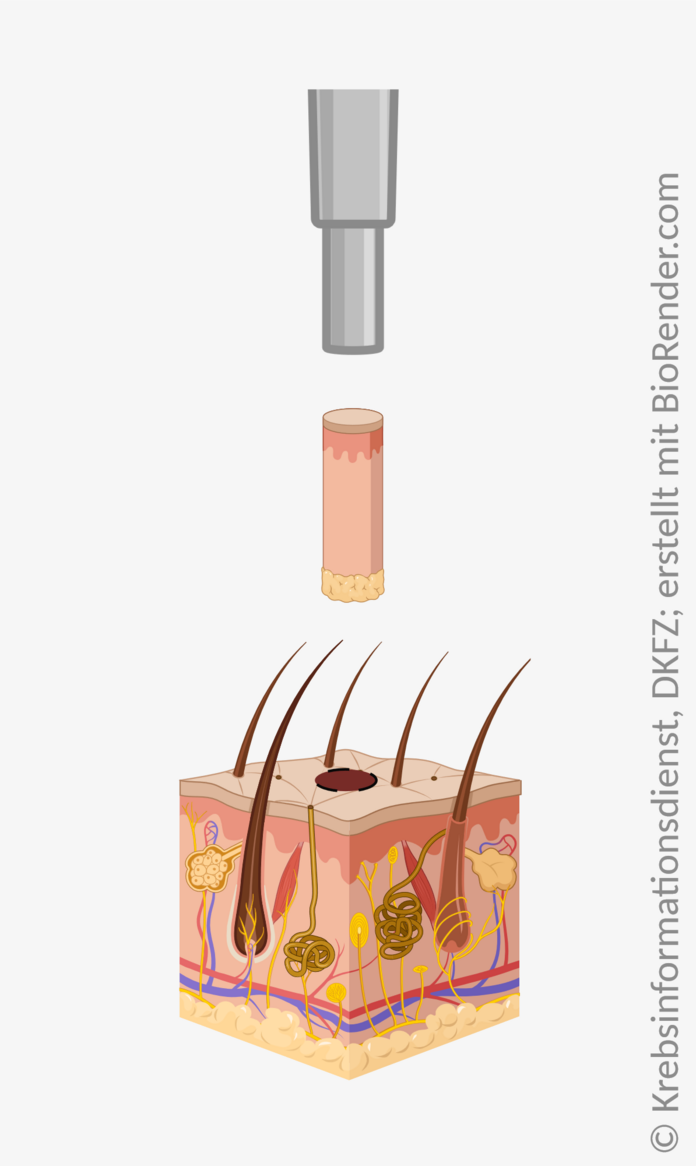 Stanzbiopsie der Haut, © Krebsinformationsdienst, DKFZ, erstellt mit BioRender.com Bei einer Stanzbiopsie der Haut wird mit einer Hohlnadel eine zylinderförmige Probe aus dem Gewebe ausgestanzt.