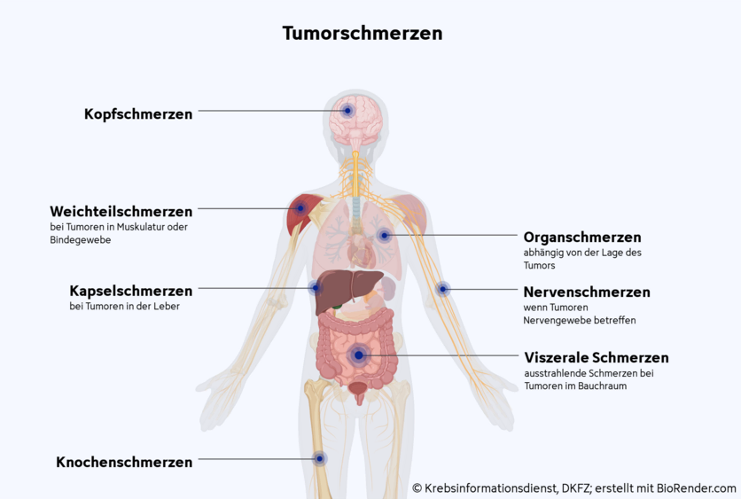 Tumorschmerzen, © Krebsinformationsdienst, DKFZ; erstellt mit BioRender.com Anatomische Ansicht eines Menschen, an dem verschiedene Formen von Tumorschmerzen gekennzeichnet sind: Organschmerzen am Gehirn, Nervenschmerzen am Nerven des Armes, Viszerale Schmerzen im Magen-Darm-Trakt, Knochenschmerzen im Oberschenkelknochen, Kapselschmerzen in der Leber, Weichteilschmerzen im Schultermuskel.