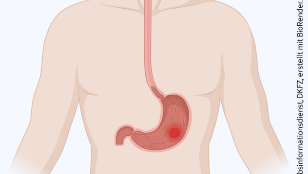 Tumor im Magen, © Krebsinformationsdienst, DKFZ; erstellt mit BioRender.com Silhouette eines Oberkörpers mit Magen und Speiseröhre. Im Magen befindet sich ein Tumor.