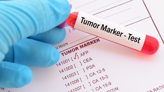 Auf einem Ausdruck stehen Abkürzungen von mehreren Tumormarkern, bei “AFP“ ist ein roter Haken. Im Vordergrund hält eine Hand mit OP-Handschuhen ein Röhrchen mit einer Blutprobe auf der “Tumor Marker-Test“ steht.