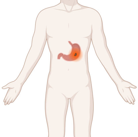 Schematische, anatomische Darstellung einer Bauchspeicheldrüse mit leuchtendem Tumor