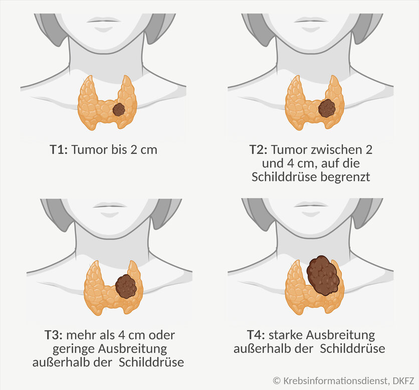 In den Stadien T1 bis T3 ist Schilddrüsenkrebs vorwiegend auf die Schilddrüse begrenzt, im Stadium 4 breitet sich der Tumor über die Schilddrüse hinaus aus.