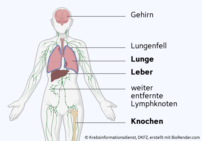 Häufige Metastasen bei Brustkrebs, © Krebsinformationsdienst, DKFZ; erstellt mit Biorender.com Grafische Darstellung der Gewebe, in die Brustkrebs am häufigsten streut: Knochen, Lunge, Leber, weiter entfernte Lymphknoten, Gehirn und Lungenfell.