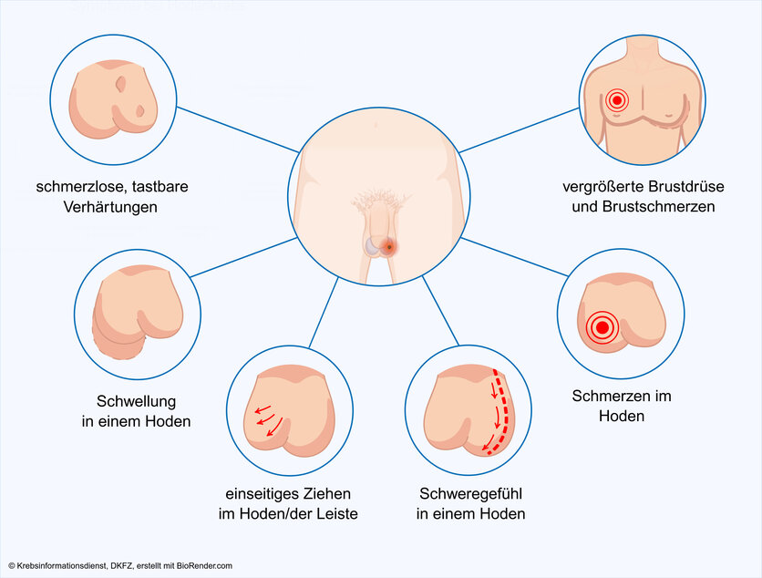 Symptome bei Hodenkrebs, © Krebsinformationsdienst, DKFZ; erstellt mit Biorender.com Graphische Darstellung der verschiedenen Symptome, die Hodenkrebs verursachen kann: ein Schweregefühl in einem Hoden, ein einseitiges Ziehen im Hoden oder in der Leiste, eine tastbare Verhärtung innerhalb eines Hodens oder an seiner Oberfläche, Schmerzen im Hoden, Vergrößerung der Brustdrüse und Schmerzen in der Brust, Schwellung eines Hodens.