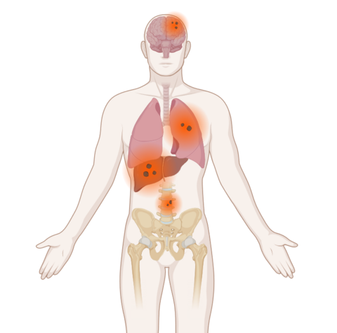 Grafische Darstellung verschiedener Metastasen im Körper