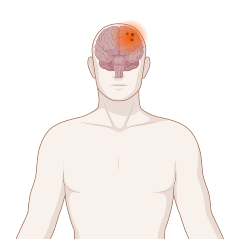Schematische, anatomische Darstellung einer Hirnmetastasen mit leuchtendem Tumor