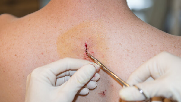 Vernähte Operationswunde, © Joel Carillet, iStock Hände mit Schutzhandschuhen vernähen eine kleine Operationswunde am Rücken