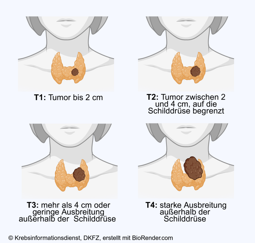 Tumorstadien bei Schilddrüsenkrebs, © Krebsinformationsdienst, DKFZ; erstellt mit BioRender.com In den Stadien T1 bis T3 ist Schilddrüsenkrebs vorwiegend auf die Schilddrüse begrenzt, im Stadium 4 breitet sich der Tumor über die Schilddrüse hinaus aus.