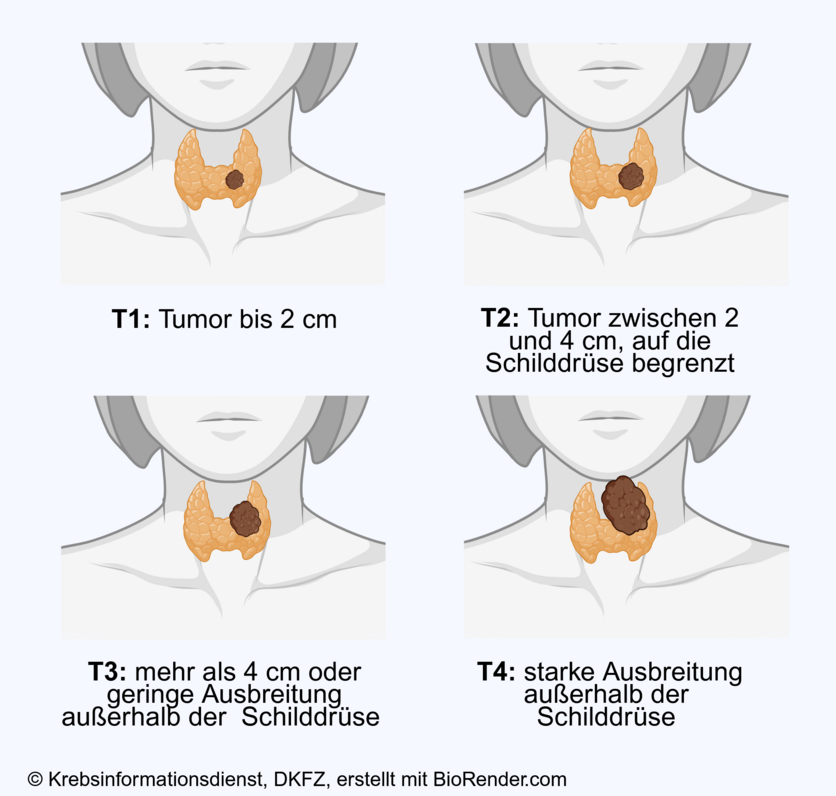 Tumorstadien bei Schilddrüsenkrebs, © Krebsinformationsdienst, DKFZ; erstellt mit BioRender.com In den Stadien T1 bis T3 ist Schilddrüsenkrebs vorwiegend auf die Schilddrüse begrenzt, im Stadium 4 breitet sich der Tumor über die Schilddrüse hinaus aus.