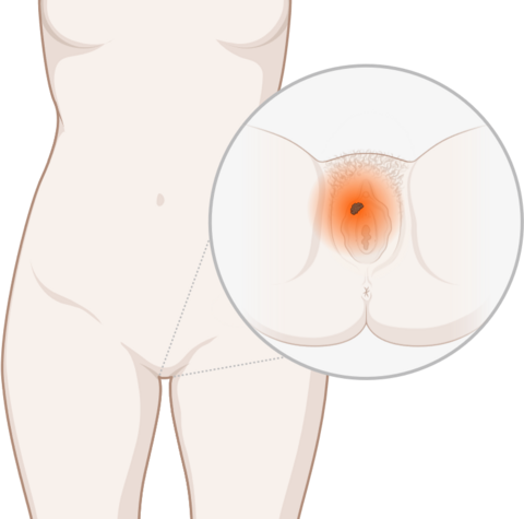 Vulvakrebs, © Krebsinformationsdienst, DKFZ; erstellt mit BioRender.com Schematische, anatomische Darstellung der Vulva und leuchtendem Tumor.