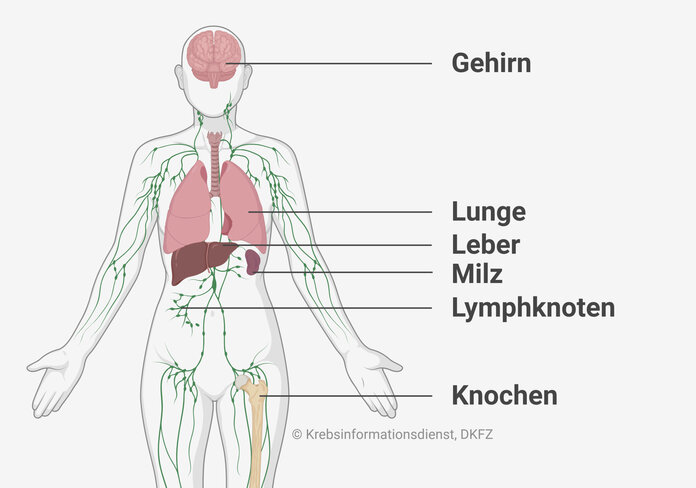 Grafische Darstellung des Körpers und verschiedener Organe, die beschriftet sind: Gehirn, Lunge, Leber, Milz, Lymphknoten und Knochen.
