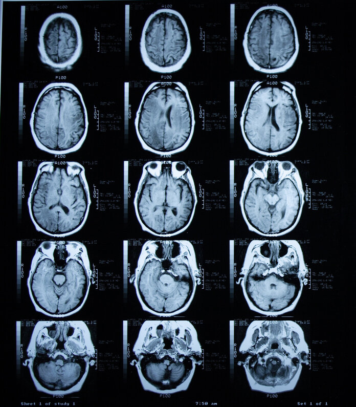Aufnahme einer Magnetresonanztomographie (MRT) des Gehirns mit (rechts) und ohne (links) Kontrastmittel.