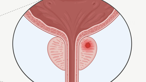 Grafische Darstellung der Lage der Geschlechtsorgane, Harnblase, Harnröhre. In der Prostata befindet sich ein Tumor (rot).