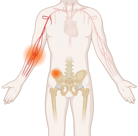 Schematische, anatomische Darstellung des Körpers mit leuchtenden Tumoren an Blutgefäßen und Beckenknochen.