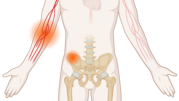 Schematische, anatomische Darstellung des Körpers mit leuchtenden Tumoren an Blutgefäßen und Beckenknochen.