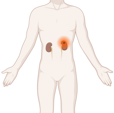 Schematische, anatomische Darstellung der Nieren mit leuchtendem Tumor.