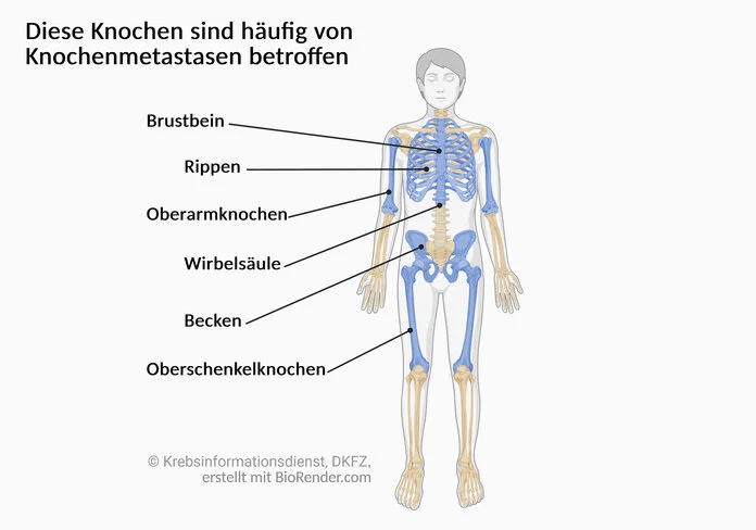 Auftreten von Knochenmetastasen, © Krebsinformationsdienst, DKFZ, erstellt mit Biorender.com Darstellung des menschlichen Skeletts. Eingefärbt sind: Brustbein, Rippen, Wirbelsäule, Becken sowie Oberarm- und Oberschenkelknochen.