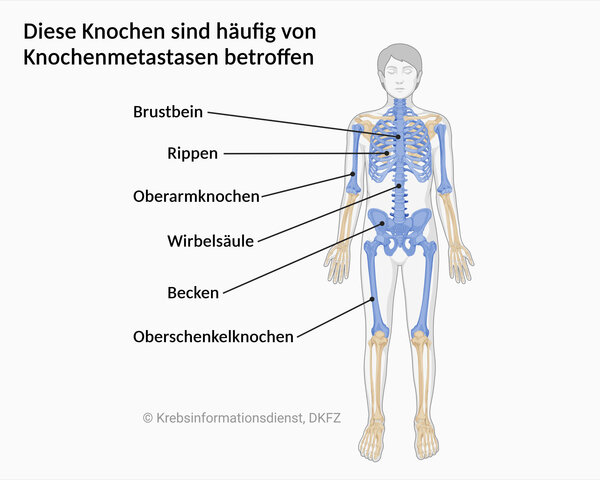 Darstellung des menschlichen Skeletts. Eingefärbt sind: Brustbein, Rippen, Wirbelsäule, Becken sowie Oberarm- und Oberschenkelknochen.