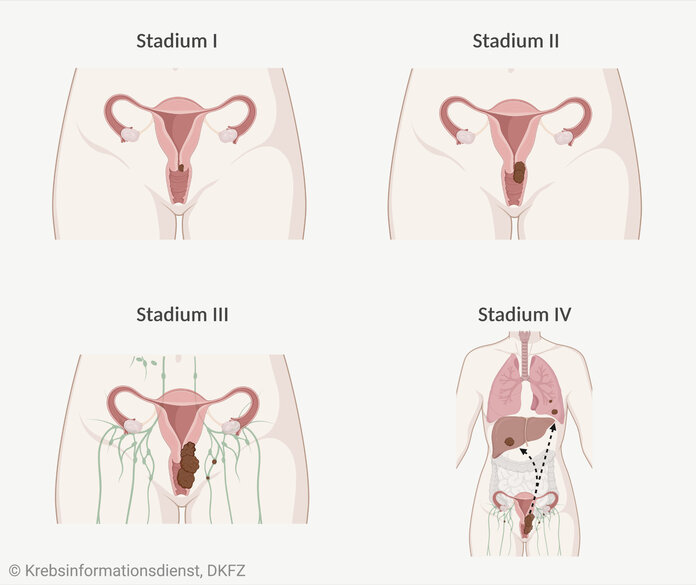 Grafische Darstellung der Stadieneinteilung bei Gebärmutterhalskrebs.