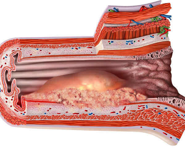 Anatomischer Querschnitt durch die Speiseröhre (Ösophagus) mit Blick auf ein Adenokarzinom (Ösophaguskarzinom)