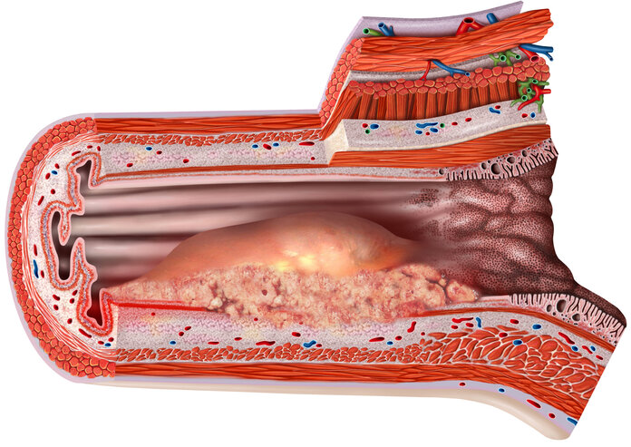 Anatomischer Querschnitt durch die Speiseröhre (Ösophagus) mit Blick auf ein Adenokarzinom (Ösophaguskarzinom)