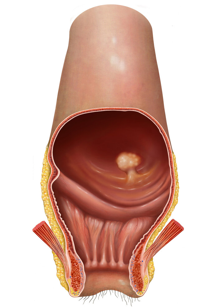 grafische Darstellung eines Darmpolypem im Darm