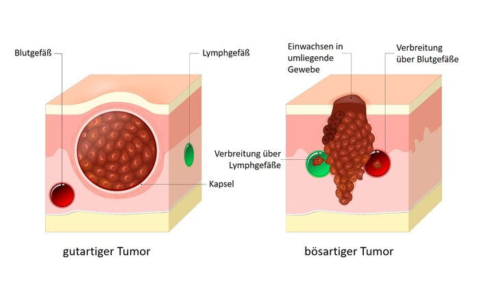 Tumor, gutartig, bösartig: Definition