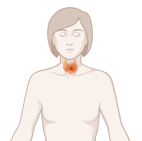 Schilddrüse, © Krebsinformationsdienst, DKFZ; erstellt mit Biorender.com Schematische, anatomische Darstellung einer Schilddrüse mit leuchtendem Tumor
