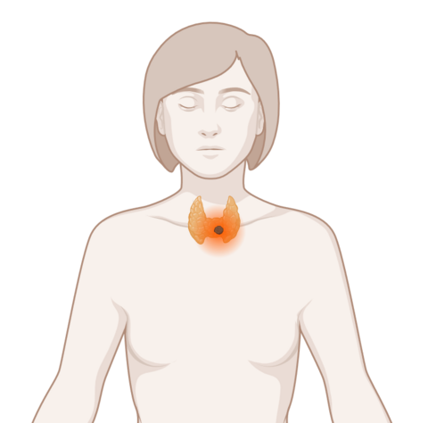 Schematische, anatomische Darstellung einer Schilddrüse mit leuchtendem Tumor