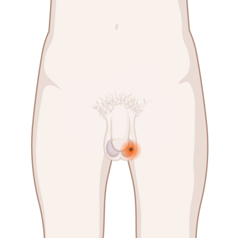 Schematische, anatomische Darstellung eines Hoden mit leuchtendem Tumor
