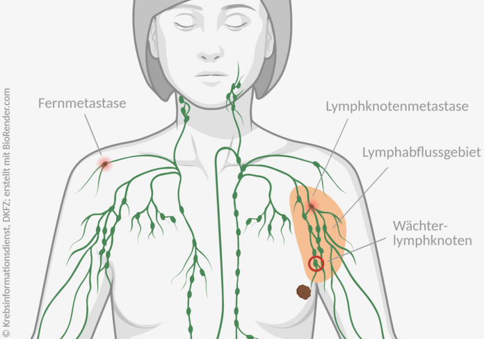 Unterschied zwischen Lymphknotenmetastasen und Fernmetastasen., © Krebsinformationsdienst, DKFZ; erstellt mit BioRender.com Anatomische Darstellung eines weiblichen Oberkörpers mit einem Tumor in der linken Brust. Das Lymphabflussgebiet ist markiert, darin ist eine Lymphknotenmetastase eingezeichnet. In der entfernten, rechten Schulter ist eine Fernmetastase in einem Lymphknoten dargestellt.