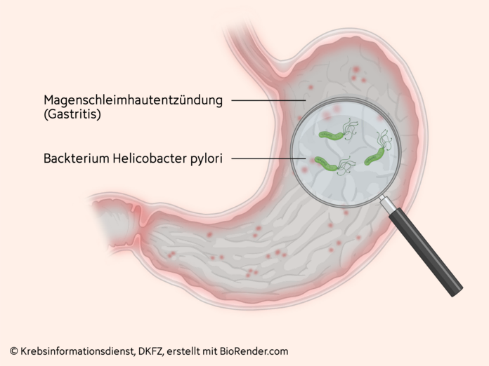 Helicobacter Infektion, © Krebsinformationsdienst, DKFZ; erstellt mit BioRender.com Grafik einer Magenschleimhautentzündung. Die Lupe vergrößert das Bakterium Helicobacter pylori