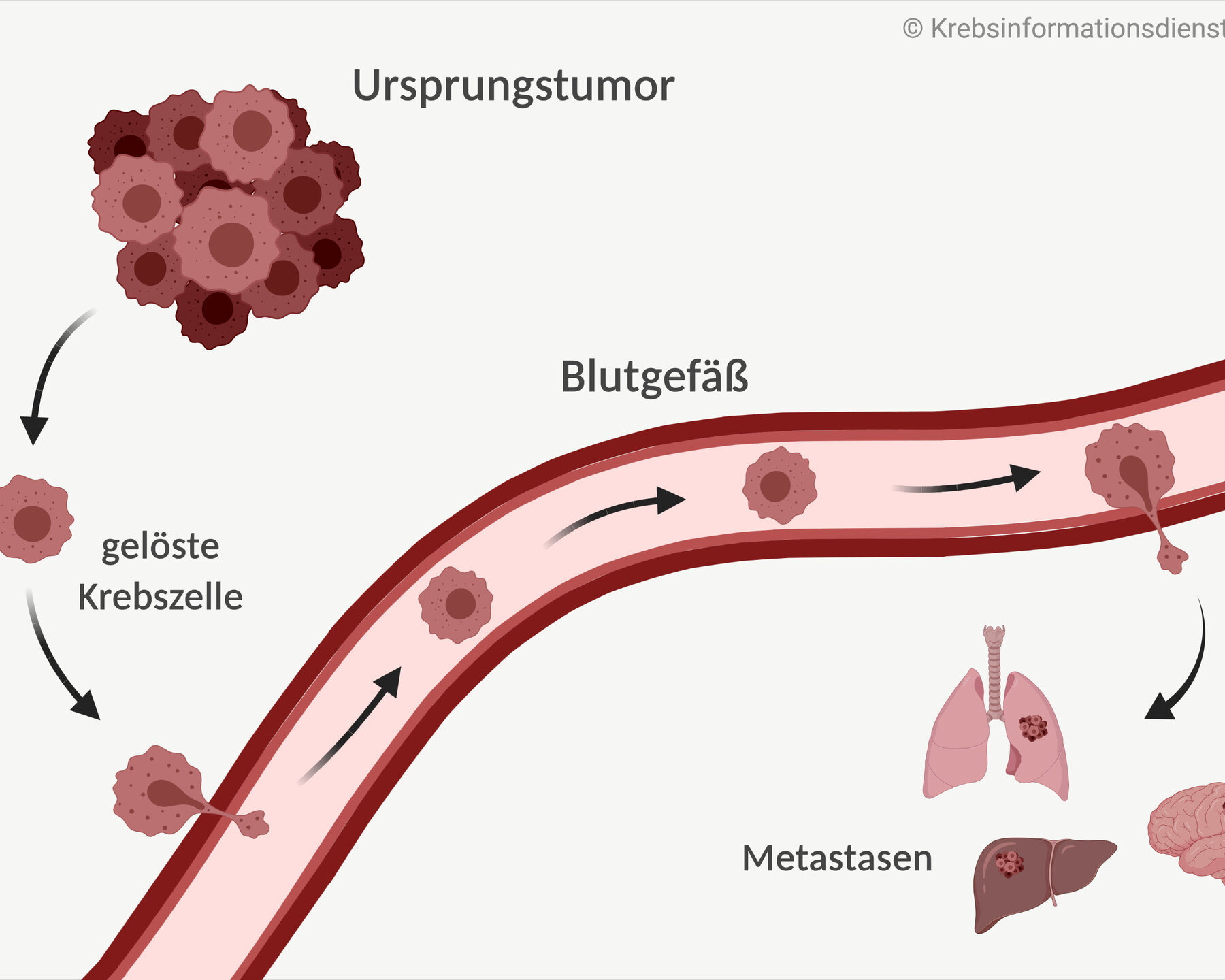 Krebsmedizin: Therapie Und Diagnose Von Krebs | DKFZ ...