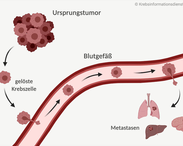 Graphische Darstellung zur Entstehung von Metastasen: Vom Ursprungstumor lösen sich Krebszellen ab und gelangen über die Blutbahn in andere Organe. Dort bilden sie Metastasen.