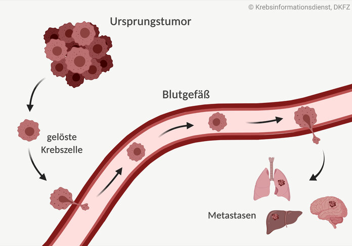 Graphische Darstellung zur Entstehung von Metastasen: Vom Ursprungstumor lösen sich Krebszellen ab und gelangen über die Blutbahn in andere Organe. Dort bilden sie Metastasen.
