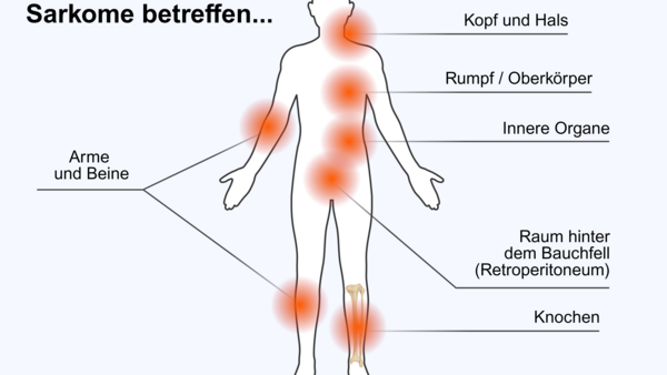 Typische Körperregionen bei RIS, © Krebsinformationsdienst, DKFZ; erstellt mit BioRender.com Die Abbildung zeigt eine Körpergrafik mit den Orten, an denen RIS hauptsächlich auftritt: Kopf und Hals, Rumpf, beziehungsweise Oberkörper, innere Organe, Arme und Beine, Raum hinter dem Bauchfell (Retroperitoneum) und Knochen.