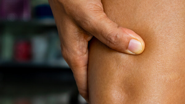 Foto von einem Lymphödem im Bein: Eine Person drückt mit dem Daumen in eine Wasseransammlung im Bein, wwodurch eine Delle zurückbleibt.