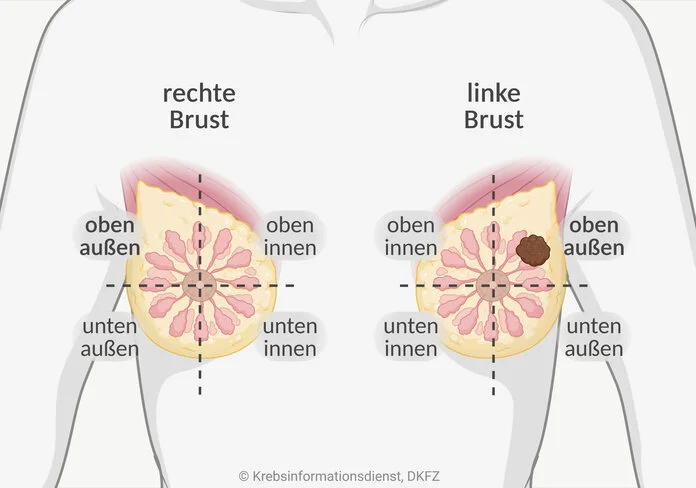 Einteilung der Brust in Viertel, © Krebsinformationsdienst, DKFZ; erstellt mit Biorender.com Grafische Darstellung der weiblichen Brüste, die jeweils durch eine senkrechte und eine waagerechte Linie, die sich auf der Brustwarze kreuzen, in Viertel eingeteilt werden.