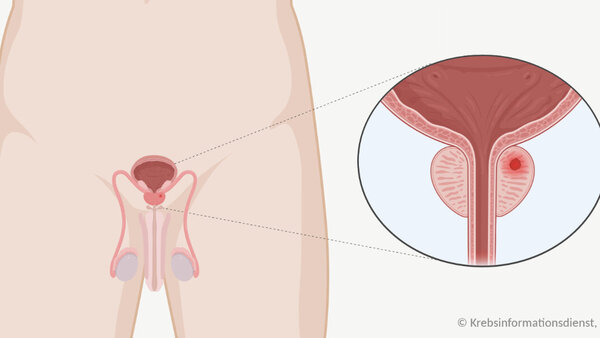 Prostatakrebs Grafische Darstellung der Lage der Geschlechtsorgane, Harnblase, Harnröhre. In der Prostata befindet sich ein Tumor (rot).