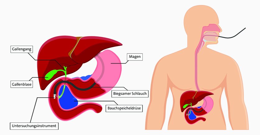 Grafische Darstellung einer endoskopisch retrograden Cholangiopankreatikographie (ERCP): Dabei bekommt der Patient oder die Patientin vom Arzt einen dünnen, biegsamen Schlauch (Endoskop) über die Speiseröhre bis zur gemeinsamen Mündung von Gallen- und Bauchspeicheldrüsengängen im Zwölffingerdarm geschoben.