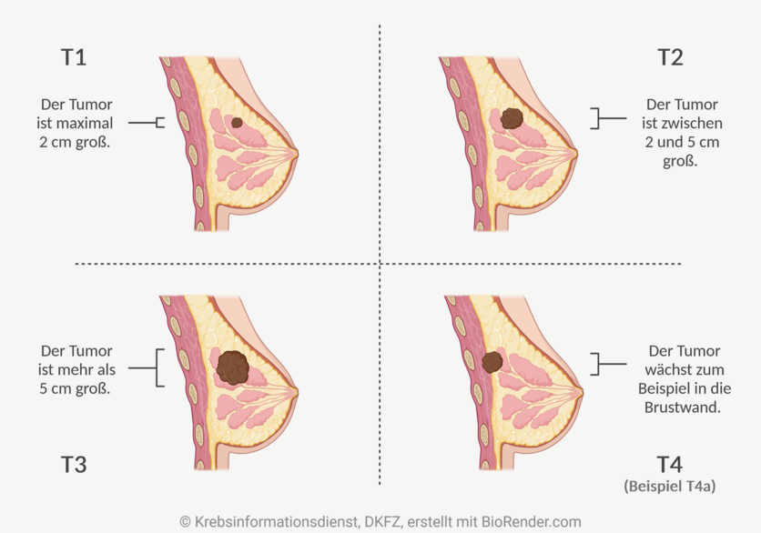 Das T der TNM-Klassifikation gibt an, wie groß der Ursprungstumor ist (Hinweis: Die Zentimeterangaben beziehen sich auf den Durchmesser des jeweiligen Tumors).