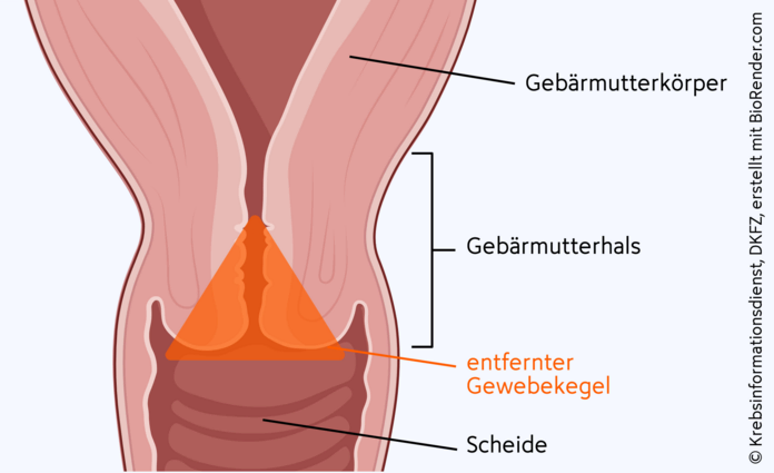 Konisation, © Krebsinformationsdienst, DKFZ; erstellt mit BioRender.com Grafische Darstellung einer Konisation, bei der die Ärzte einen Gewebekegel aus dem Gebärmutterhals ausschneiden.