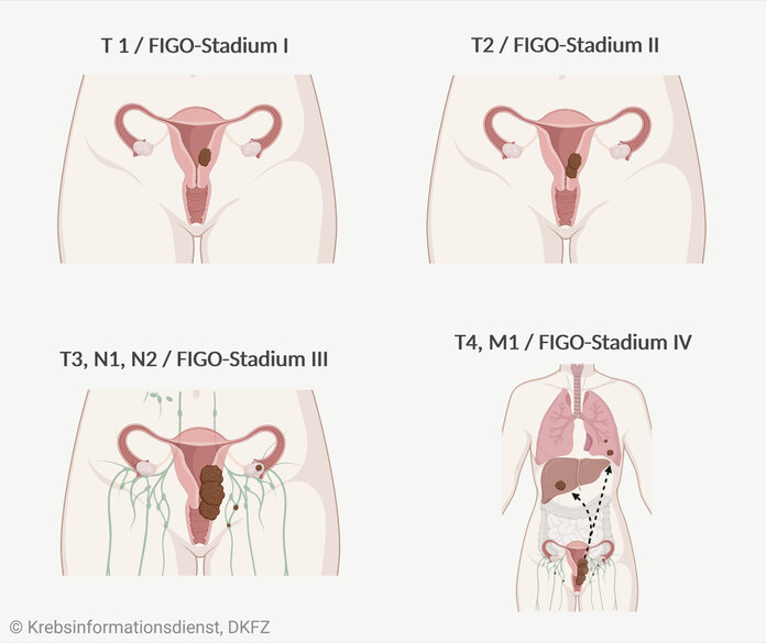 Gebärmutterkörperkrebs Stadieneinteilung