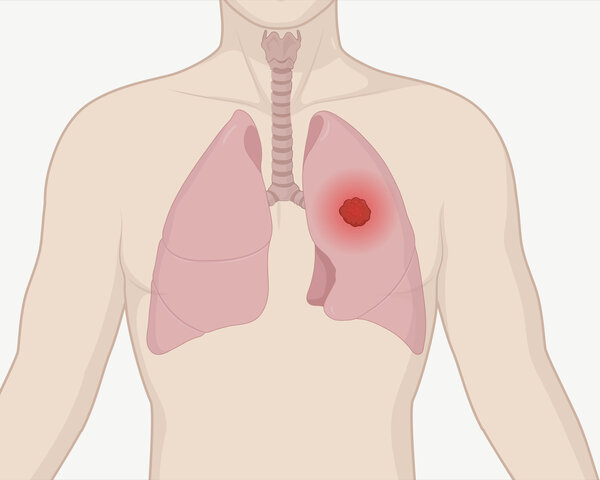 Grafik eines menschlichen Oberkörpers mit Lunge und Luftröhre. Ein Tumor in der Lunge ist als leuchtender Punkt dargestellt.