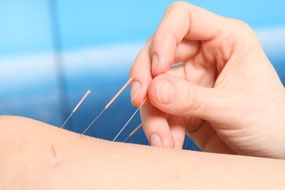 Mehrere Akupunkturnadeln in der Haut einer Person.