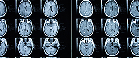 MRT-Bild Hirnmetastasen, links ohne, rechts mit Kontrastmittel © Dean Hoch, Thinkstock